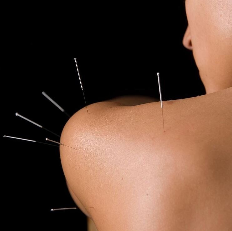 acupuncture image 1