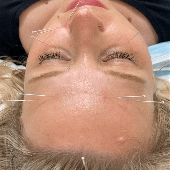 facial acupuncture
